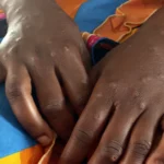 Healthcare worker in the Democratic Republic of Congo addressing mpox patients in a conflict-affected area