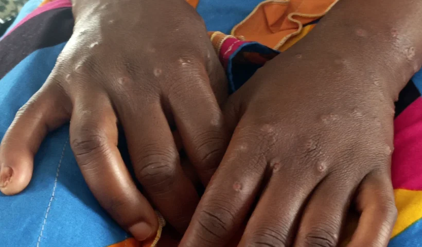 Healthcare worker in the Democratic Republic of Congo addressing mpox patients in a conflict-affected area