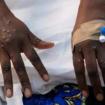 Health workers in Ethiopia respond to the Marburg virus outbreak during surveillance and containment efforts.